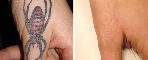 tattoo_removal_dr_ahcan2